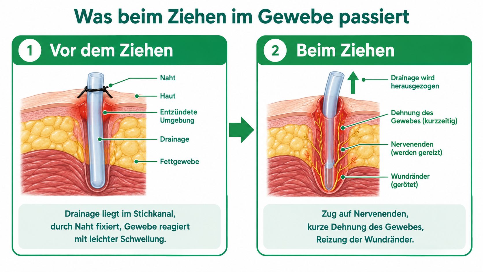 Illustration des medizinischen Prozesses beim Ziehen einer Wunddrainage aus dem menschlichen Gewebe mit erklärenden Hinweisen.